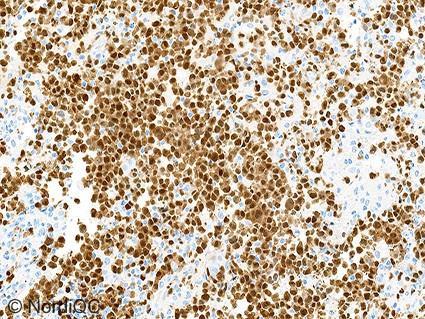 If these cells/structures were negative, a too weak or even completely false negative staining reaction was seen in the lung adenocarcinoma with EML4-ALK translocation and Merkel cell carcinoma.