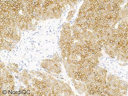 2a. The neoplastic cells only display a very faint cytoplasmic staining reaction. Fig.