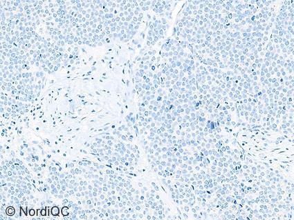 Most of the neoplastic cells show a moderate to strong granular cytoplasmic staining reaction.