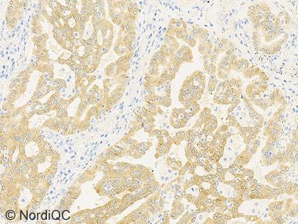 5a Optimal ALK staining of the lung adenocarcinoma with ALK rearrangement using the Ventana RTU system based on rmab D5F3 following the recommended Ventana
