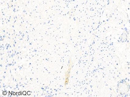 to strong staining reaction. Fig. 7b Insufficient ALK staining of the appendix using same protocol as in Figs.