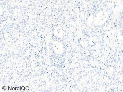 8b Optimal ALK staining of the lung adenocarcinoma without ALK rearrangement using same protocol as in Figs.