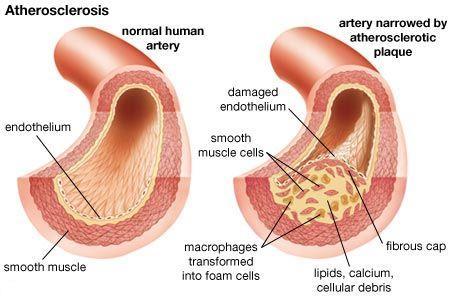 Causes of CAD CAD is caused by plaque buildup in the walls of the arteries that supply blood to the heart (called coronary arteries) and other parts of the body.