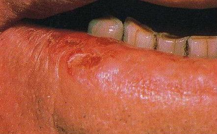 Figure 1: Squamous cell Carcinoma of the lip 16 The early signs of premalignant changes of the oral mucosa may present as either leukoplakia (white patches) or erythroplakia (red patches).