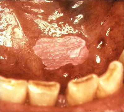 17 During an examination, a lesion may be considered to be leukoplakia (Figure 1) if it cannot be attributed to another condition such as lichen planus (Figure 3), candidiasis (Figure 4) or lichenoid