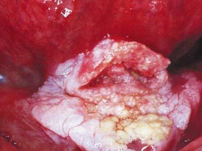 become nodular or develop a papillary surface and are known as verrucous leukoplakia (figure 2).