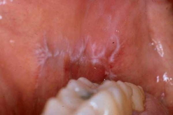 It is also reported that thicker or verrucous leukoplakia are more likely to show dysplasia or malignancy than thin leukoplakia (figure 2). 19 Figure 2. Verrucous leukoplakia.