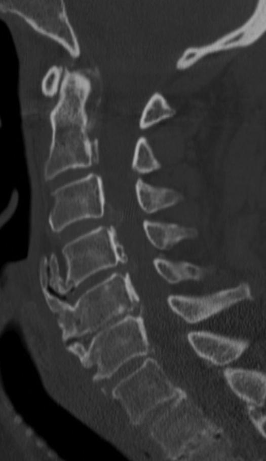 the spinal cord by releasing the posterior elements, allowing posterior spinal cord drift and subsequent relief of anterior compression (Figures 1 3).