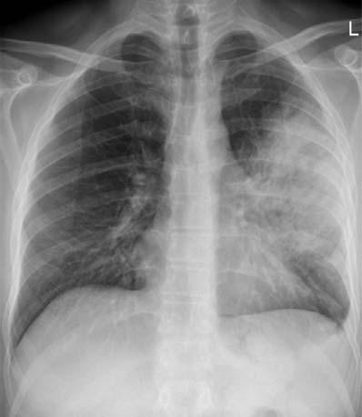 Definition and incidence of scap CAP is defined as An acute illness with clinical features of lower respiratory tract infection, presenting with radiological infiltrations and no other explanation of