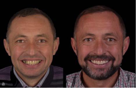 Journal of Interdisciplinary Medicine 2017;2(S1):68-72 71 FIGURE 4. a Initial situation, b Facial appearance with the mock-up. ing second upper left premolar.