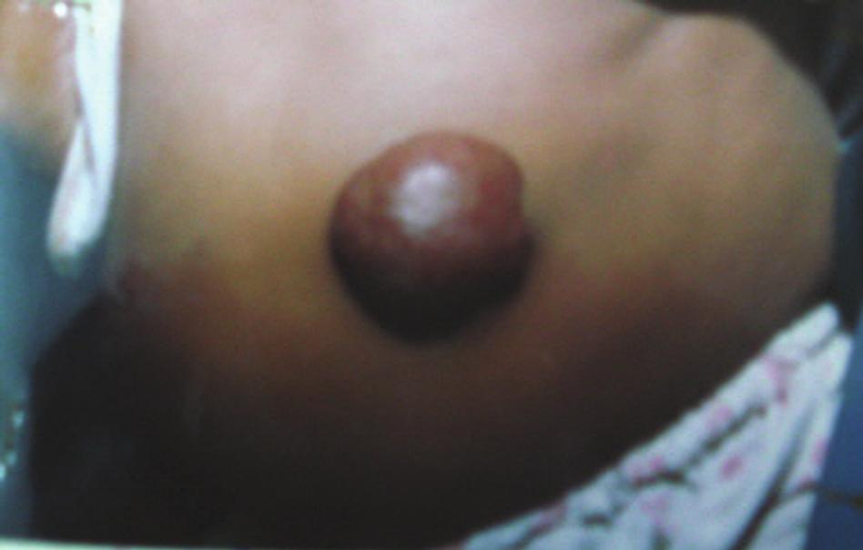 and therapeutic modalities, a literature search of PubMed was conducted of English-language articles published between 1985 to 2006 using the term hemangioma in conjunction with types,