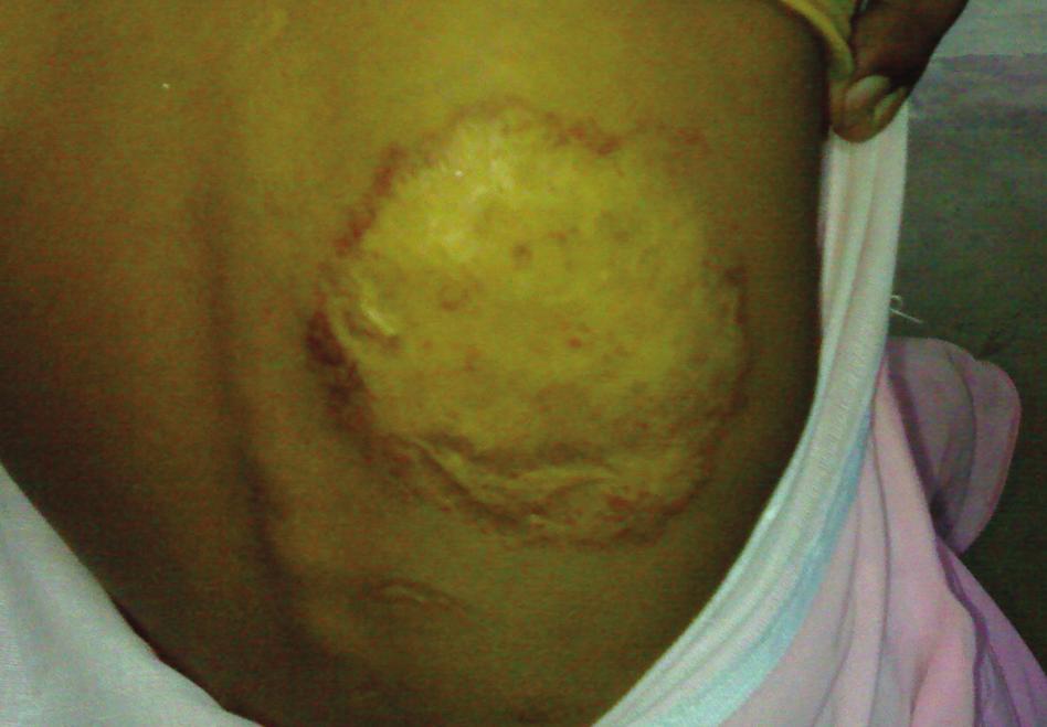 Figure 2. Healed hemangioma with obvious scarring. phase, the skin becomes irregular, raised, and bright crimson.