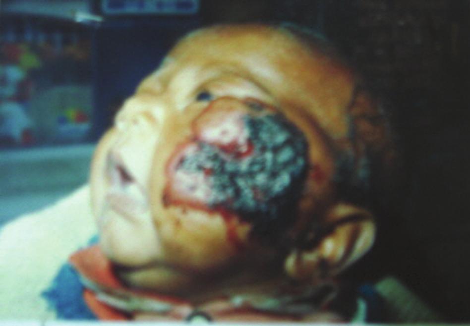 Figure 4. Ulcerated facial hemangioma. Central ulceration is clearly visible. growth may be rapid and unpredictable.