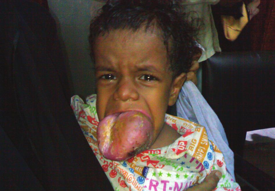 Figure 6. Large hemangioma of the tongue. Lesions like this often cause airway obstruction. according to a prospective study and one case report, respectively.