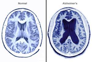 occurs in 70% of Alzheimer s