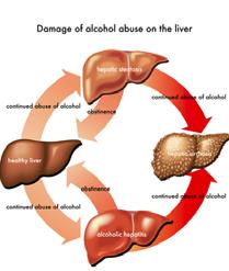 Alcohol-induced Liver Disease: Fatty Liver: accumulation of fat in the hepatocytes (steatosis) The liver enlarges and becomes yellowed by the fat accumulation.