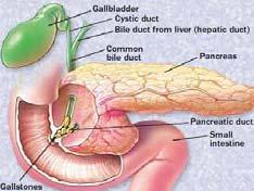 Chronic inflammation is the result of several acute cholecystitis attacks which can eventually damage the gallbladder.