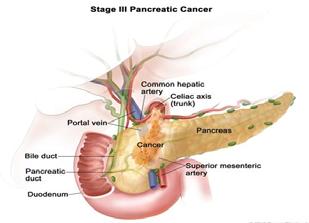 Pancreatitis: Chronic Pancreatitis: irreversible, progressive destruction of the exocrine pancreas by fibrosis and in the later stages by the destruction of the endocrine portions of the pancreas.