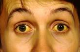Jaundice: is a manifestation associated with various disease conditions and is characterized by