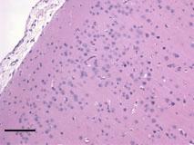 Bar = 1 lm; (E) photomicrograph of the optic nerve depicting inflammatory response and karyomegalic inclusion (insert). Bar = 1 lm; (F) Photomicrograph of cerebral cortex depicting astrogliosis.