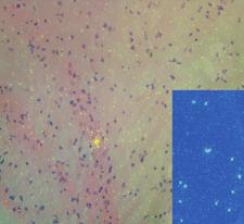 Histopathology of the cerebral cortex showed diffuse astrocytosis and astrogliosis (Fig.