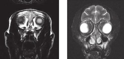 García et al. R5 clade C SHIV: AIDS and optic neuritis Fig. 2 (A) Normal rhesus monkey and (B D) monkey RQ3911 with bilateral enlargement of both optic nerve sheaths.
