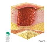 Stages of Pressure Ulcer Pressure Ulcers are stages the following system : From NPUAP 2007 Category Definition Diagram Stage Ⅲ Full-thickness tissue loss.