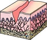 Secondary Skin Lesions (Cont d) Fissure Epidermis, dermis vertical loss, sharply defined walls Crack 28 Secondary Skin Lesions (Cont d) Excoriation Linear erosion from