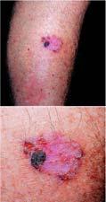 Nonmelanoma Basal cell carcinoma Skin Cancers 32 Skin