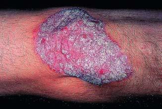 Psoriasis (Cont d) History and physical findings Red, discrete, flat-topped persistent plaques, papules with thick, silvery scales Physical examination 55 Psoriasis (Cont d) Differential diagnosis