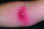 Bacterial Skin Infections (Cont d) Furuncles and carbuncles Therapeutic interventions Warm compresses Incision