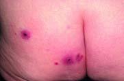 Bacterial Skin Infections (Cont d) Cellulitis History and physical findings Swollen, red area of skin Hot,