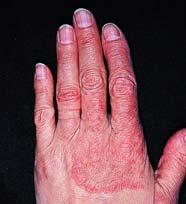 Fungal Skin Infections (Cont d) Tinea Manus 79 Fungal Skin Infections (Cont d)