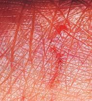 Parasitic Infestations (Cont d) Scabies 94 Viral Skin Infections Common cause of skin infection Direct inoculation into epidermal cells of skin Papova Warts, human papillomavirus Pox Molluscum