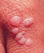 Viral Skin Infections (Cont d) Warts and papillomavirus Therapeutic interventions Destruction, painful Cryotherapy