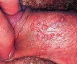 d) Warts Human Papillomavirus 98 Viral Skin Infections (Cont d) Varicella (chickenpox) and variola (smallpox)