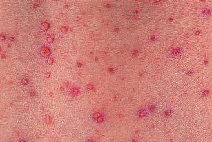 Viral Skin Infections (Cont d) Varicella 103 Viral Skin Infections (Cont d) Herpes simplex Description, definition, etiology HSV-1, oral HSV-2, genital Recurrent 104 Viral