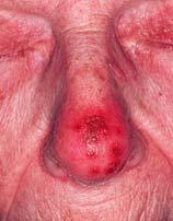 Viral Skin Infections (Cont d) Herpes simplex Differential diagnosis Impetigo Contact/atopic dermatitis Fungal infections Culture 106 Viral Skin Infections (Cont d) Herpes simplex Therapeutic