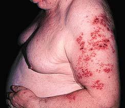 Viral Skin Infections (Cont d) Herpes Zoster 112 Specialized Erythema Urticaria (hives) Description, definition, etiology Hives Wheal forms edema Reaction to drug, contact with substance causing