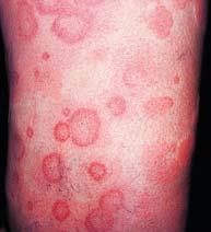 Specialized Erythema (Cont d) Urticaria (hives) Therapeutic interventions Suspicious medication discontinued Antihistamines 115 Specialized