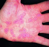Specialized Erythema (Cont d) Erythema multiforme History and physical findings History of drug use Three color zones 118 Specialized Erythema (Cont d) Erythema multiforme