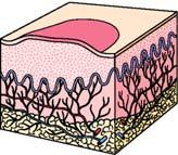 Primary Skin Lesions (Cont d) Wheal Firm, rounded, flattopped elevation of skin Evanescent Pruritic 19 Primary Skin Lesions