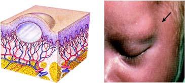Primary Skin Lesions (Cont d) Pustule Contains purulent material 22 Primary Skin Lesions (Cont d) Cyst