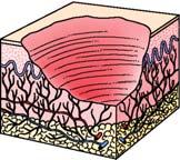 d) Ulcer Full-thickness crater Involves dermis,