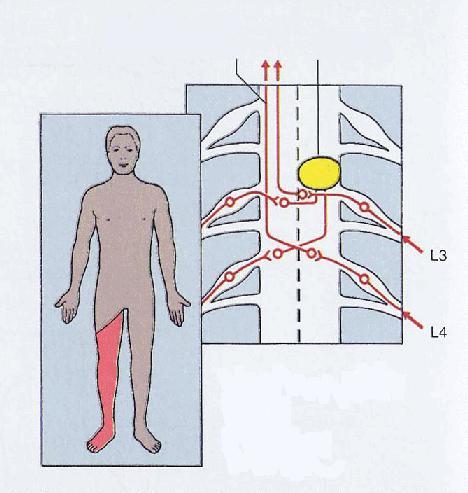 Spinothalamic damage spinothalamic pathway Left spinal cord