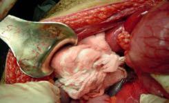 solid organ bleeding Ligation or shunt