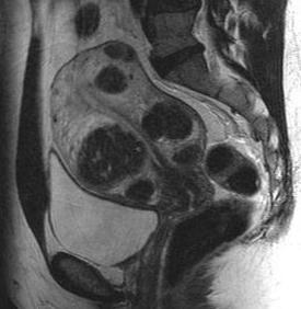 MRI of Leiomyomas Pre/post UAE Fine anatomic detail Accurate size and