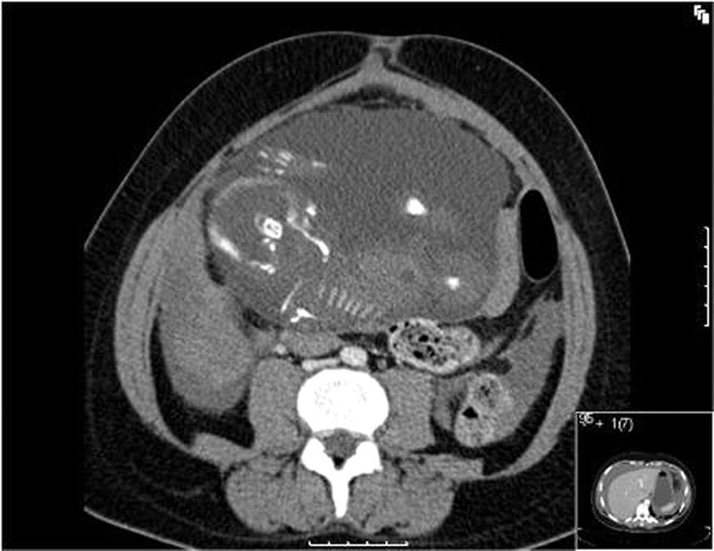 CT less common for Gyn eneteric causes mimicking pelvic