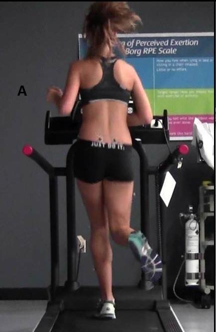 Gluteals control femoral IR and pelvic drop Gluteals found to be inhibited in runners with