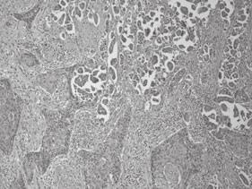 Intraparotid lymph node metastases were also present around the tumor.